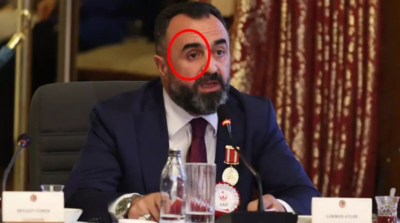 TBMM komisyonunda tarihi an! Lokman Aylar protez gözünü çıkarıp konuştu: Teröre bedel ödedim! 1