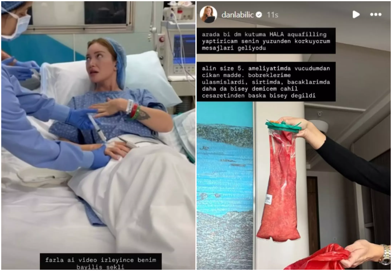 Danla Bilic, 5. ameliyatta vücudundan çıkan dolgu maddesini paylaştı! Görenler şaşkına döndü 4