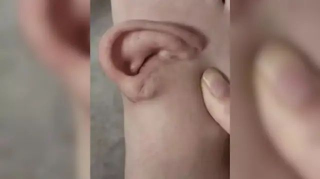 Böyle tedavi görülmedi! Kopan kulak ayağa dikildi, 5 ay sonra geri nakledildi 3