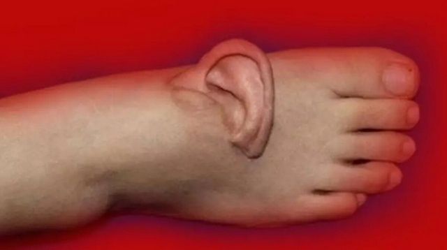 Böyle tedavi görülmedi! Kopan kulak ayağa dikildi, 5 ay sonra geri nakledildi 2