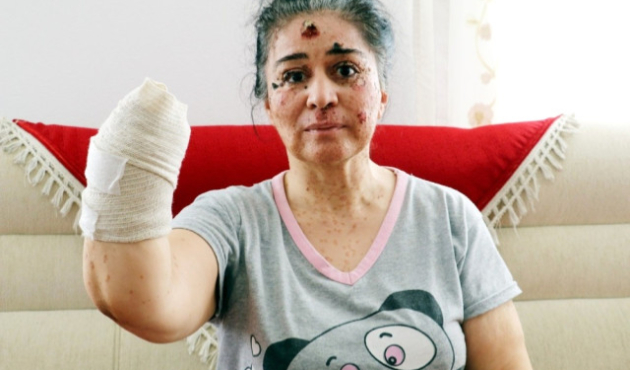 Güneşin erittiği kadın! Elini de kaybetti...