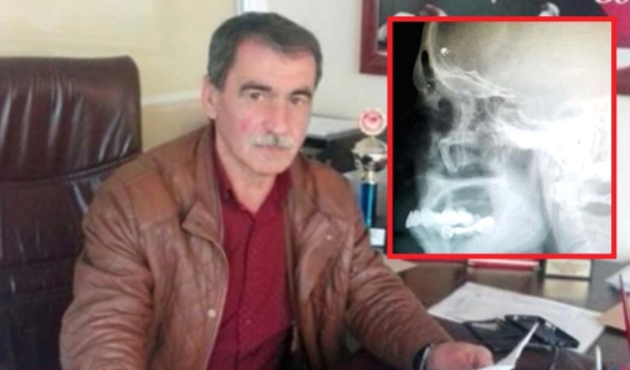 Kafasında kurşunla 40 yıl yaşadı!