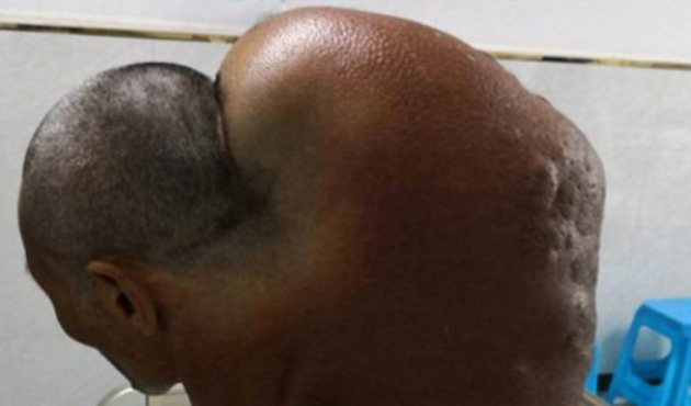 Yaşlı adamın boynundan 15 kiloluk tümör çıkartıldı!