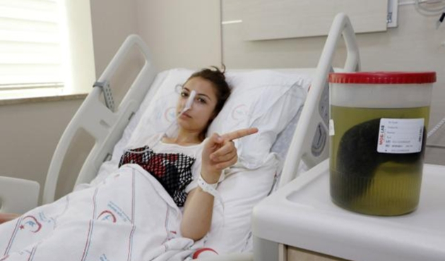 Midesinden 1,5 kilogram saç çıktı...