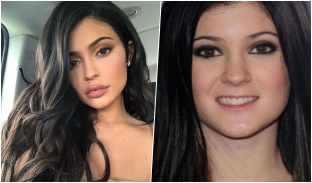 Dudak dolgusu eriyen Kylie, eski haline döndü!
