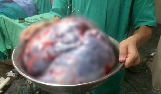 Yaşlı kadının karnından 35 kilo tümör çıktı!