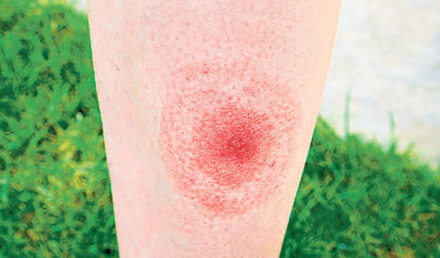 Çağın salgını: Lyme!