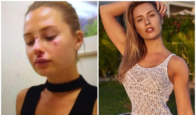 Chloe Ortaç'ın kaza yapma sebebi nazar değil alkol çıktı!