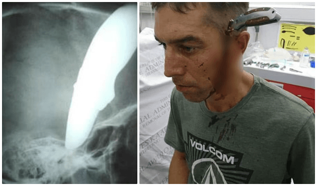 Başına saplanmış 15 cm'lik bıçakla hastaneye geldi