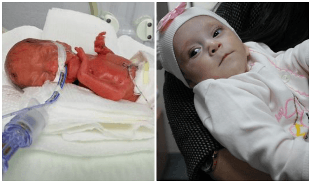 285 gram doğan Elçin yaşama sıkı sıkı tutundu!