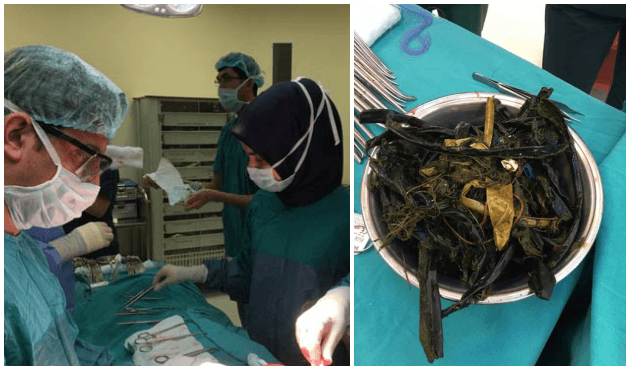 Karnından çıkanlar doktorları bile şoke etti!