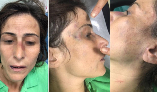 Eşinin kemiklerini kıran doktora 'takdir indirimi'
