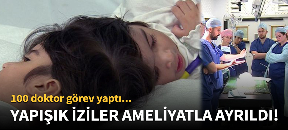 Yapışık ikizler ameliyatla ayrıldı!