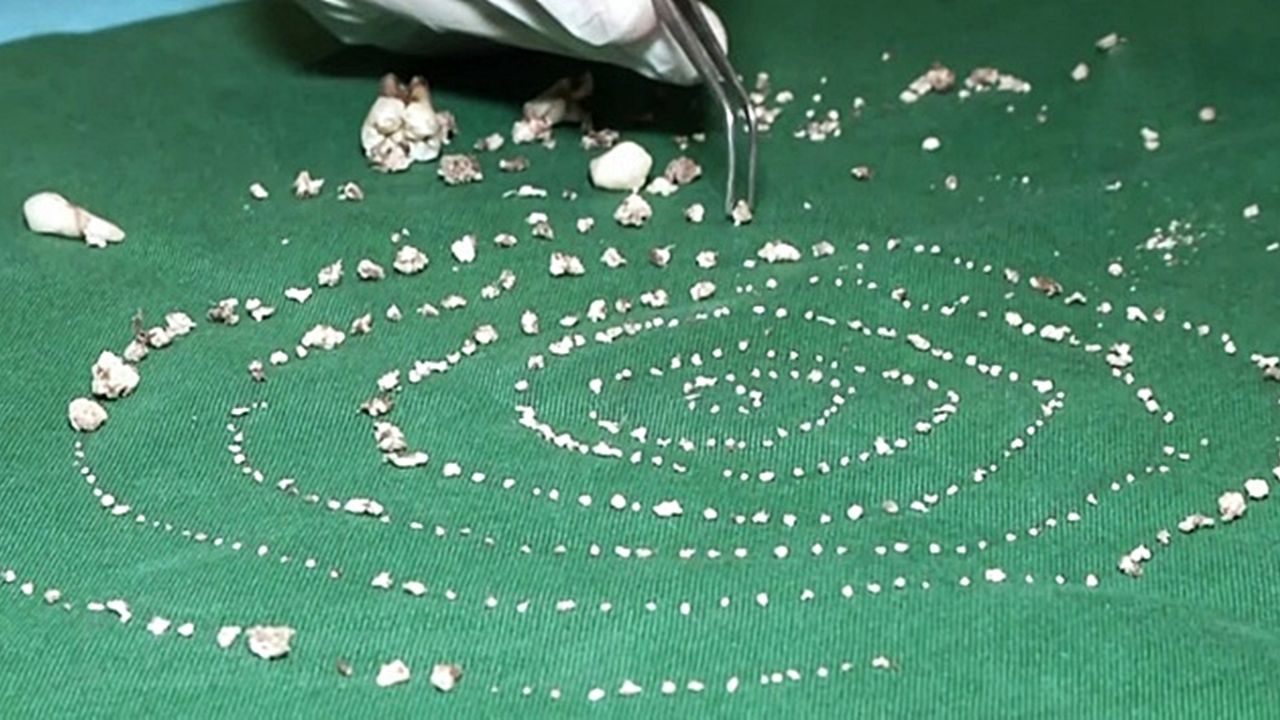 Küçük çocuğun ağzından 526 diş çıkarıldı!
