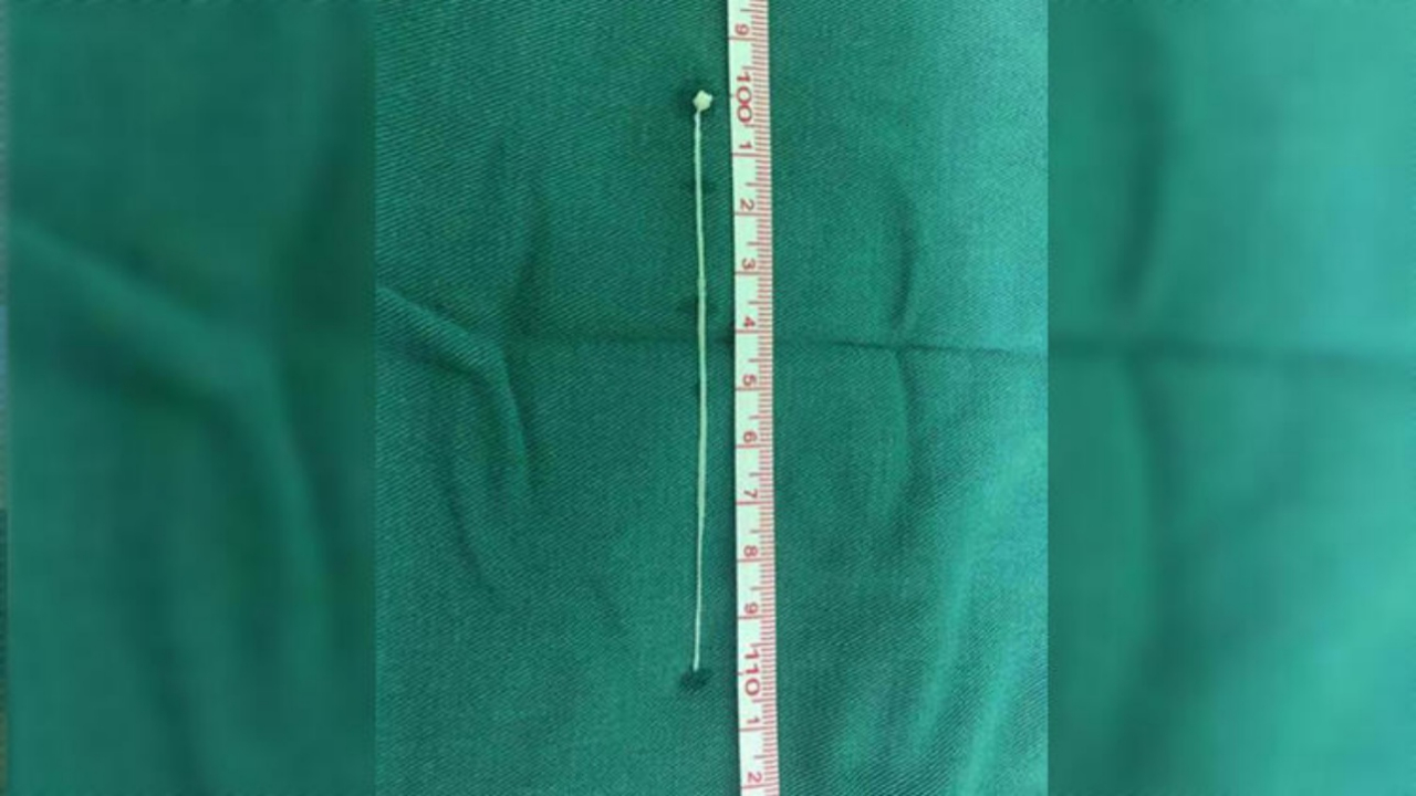 30 yıl boyunca beyninde onunla yaşadı!