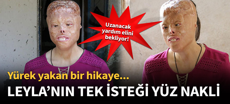 Yürek yakan bir hikaye! Tek isteği yüz nakli