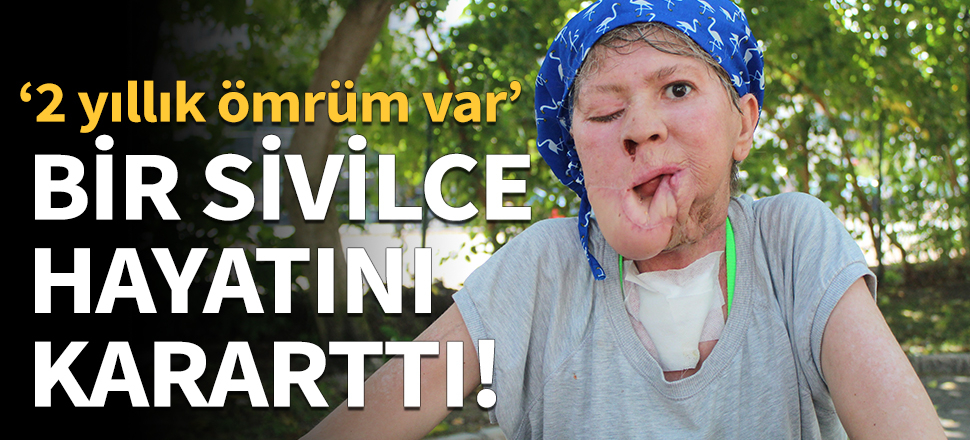 Önemsemediği sivilce onu bu hale getirdi!