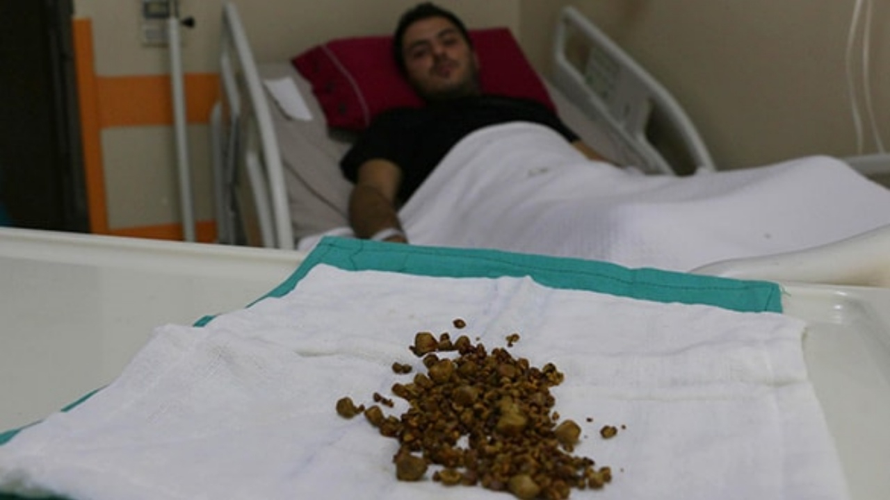 Vücudundan çıkanlar doktorları bile şaşırttı!