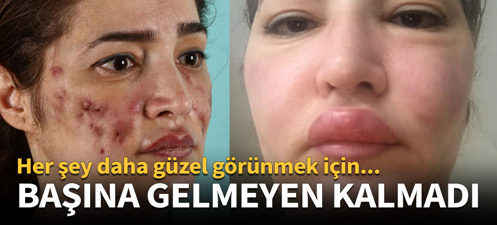 Estetik ameliyattan sonra başına gelmeyen kalmadı