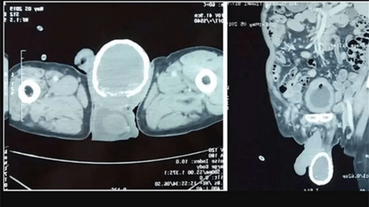 Testisleri yumurta kabuğu ile kaplandı!