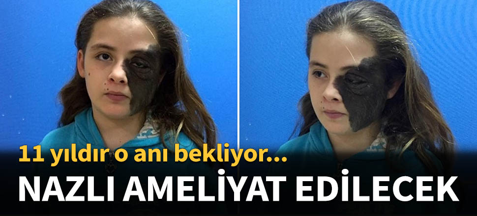 Nazlı'nın yüzündeki ben operasyonla alınacak...