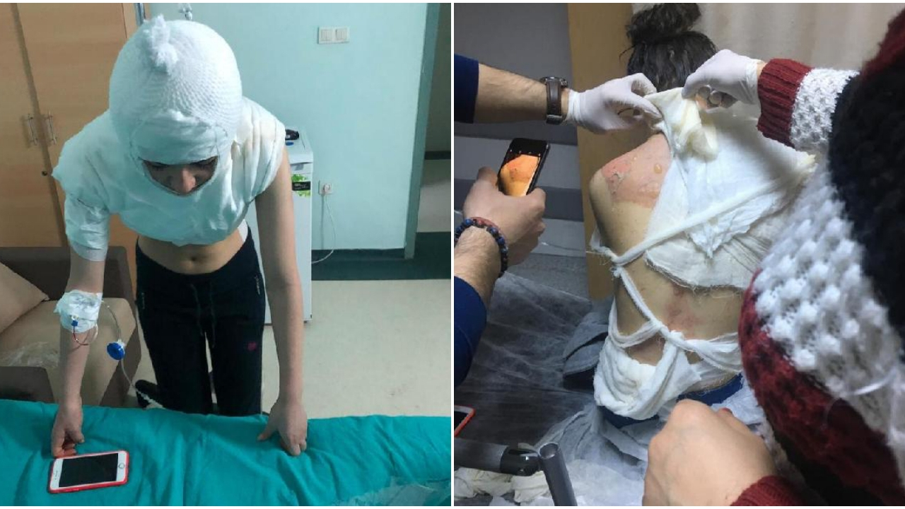 14 yaşındaki kızın başından aşağı kaynar su döktü