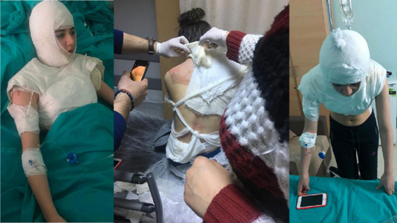 Üvey anne dehşeti! Yanıklar içinde hastaneye kaldırıldı