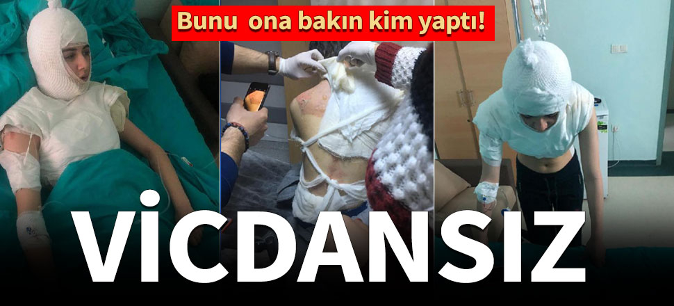 Üvey anne dehşeti! Yanıklar içinde hastaneye kaldırıldı