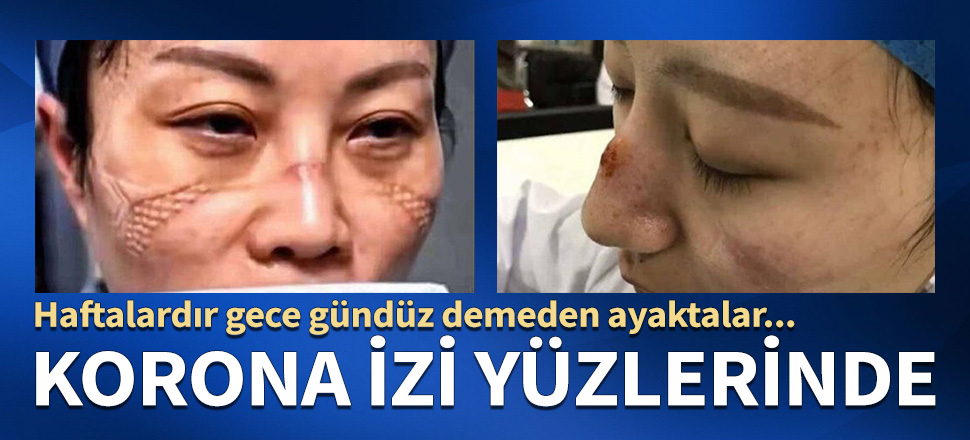 Korona izleri yüzlerinde