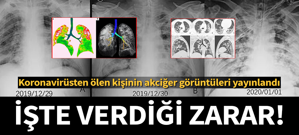 İşte koronavirüsün akciğerlere verdiği hasar