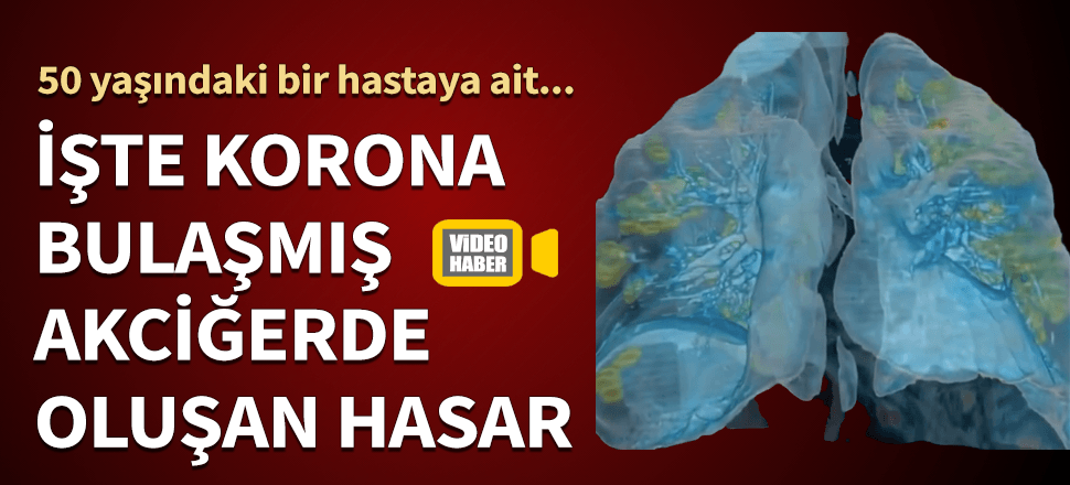 İşte koronavirüsün akciğerlerde yol açtığı hasar!