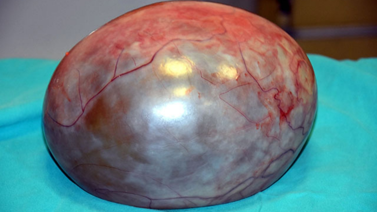 Karnından çıktı! Tam 3 kilo 400 gram