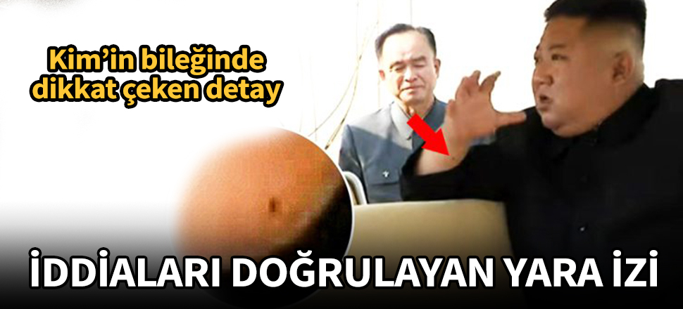 Kim'in bileğinde dikkat çeken yara detayı