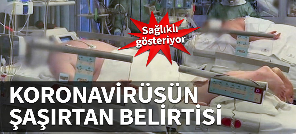 Koronavirüsün şaşırtan belirtisi! Sağlıklı gösteriyor