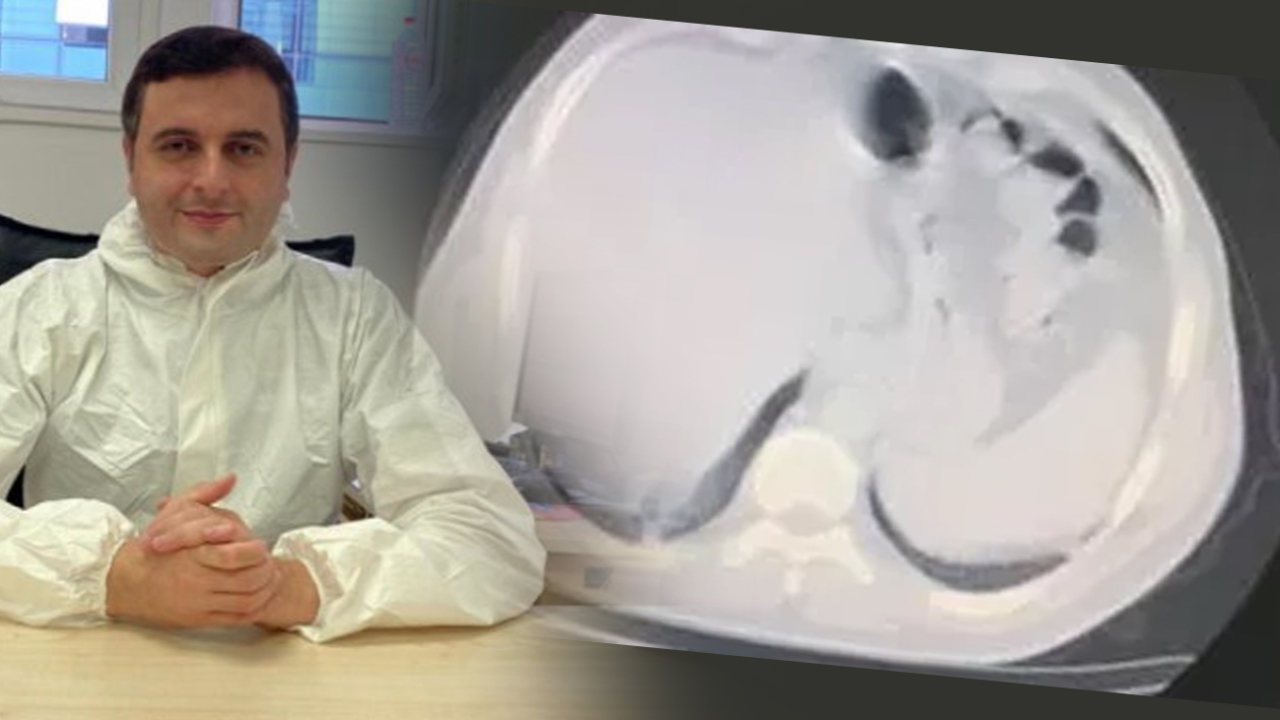 Son dakika... Koronavirüsü yenen doktor Celal Civil anlattı: Bilinç kaybı yaşadım, akciğerimin yüzde 70’ini virüs kaplamıştı