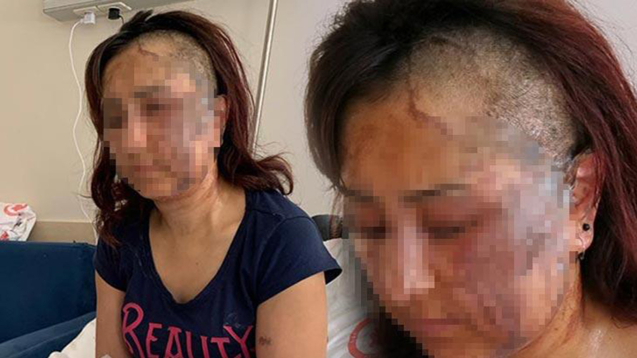 Boşanmak isteyen üç çocuk annesi eşine kezzapla saldırdı!