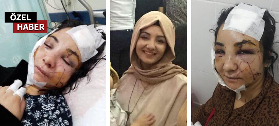Son dakika... Yüzüne, boynuna ve ellerine 120 dikiş atılan kadın SuperHaber'e konuştu: Çocuklarım yüzüme bakmaktan korkuyorlar