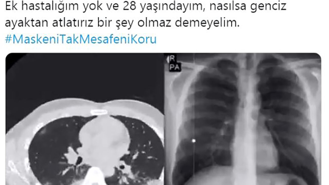 Gençleri tomografisiyle uyardı