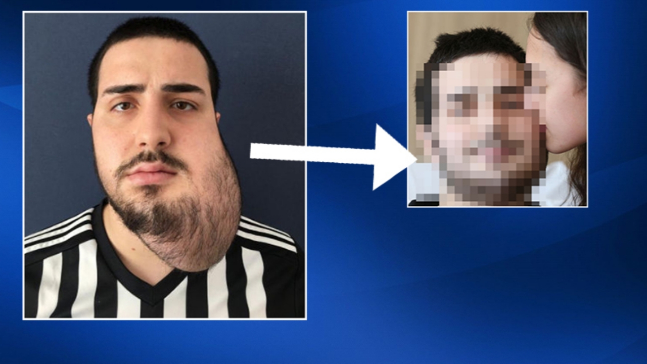 Yüzünün yarısı alındı, bacağından yeni yüz yapıldı!