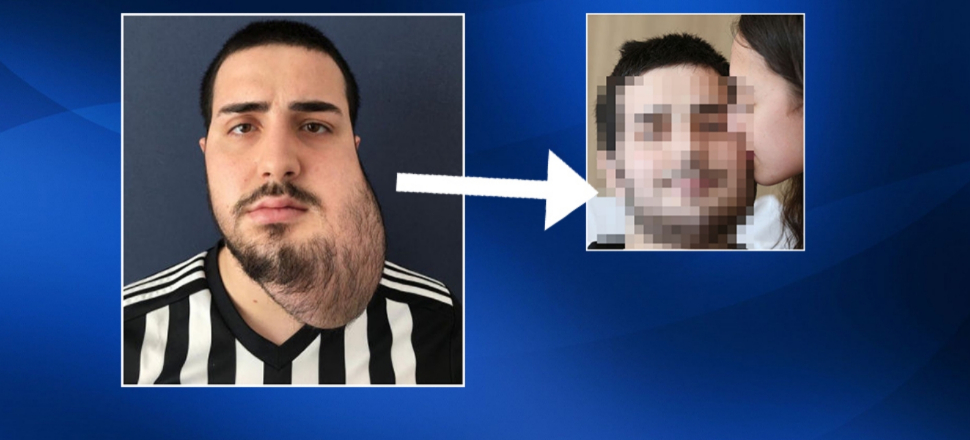 Yüzünün yarısı alındı, bacağından yeni yüz yapıldı!