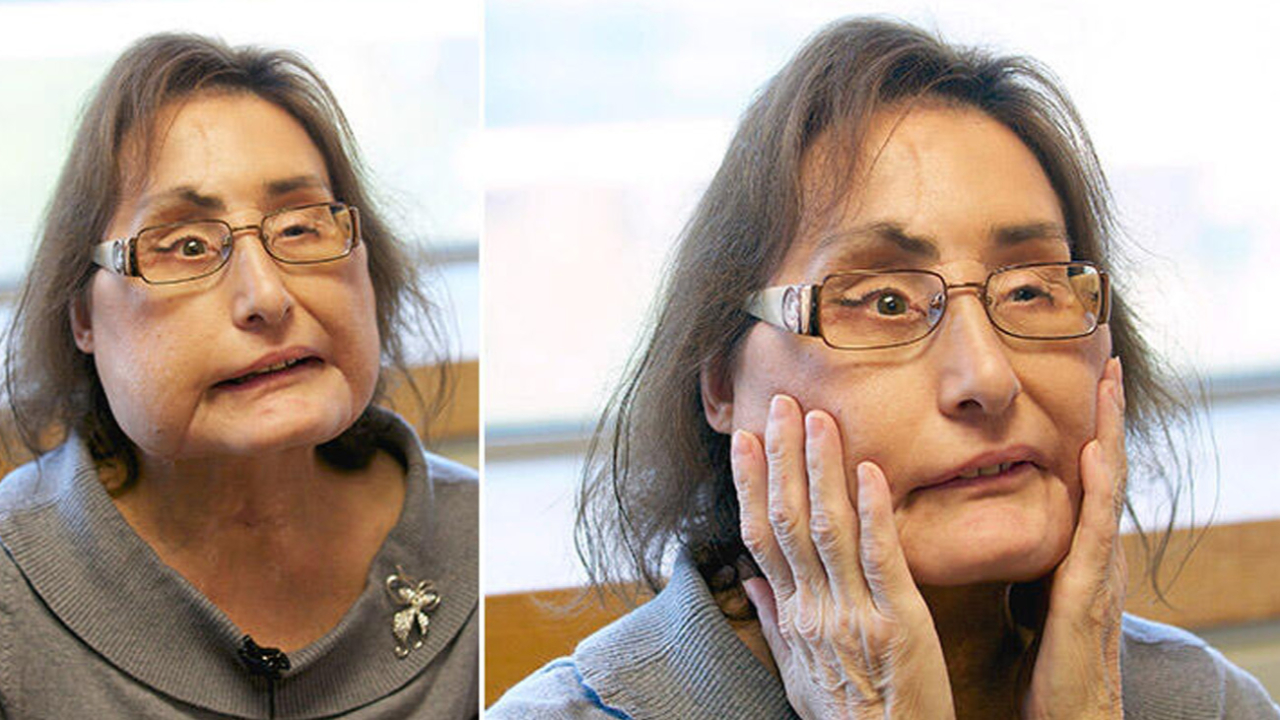 ABD’de ilk yüz nakli yapılan Connie Culp hayatını kaybetti