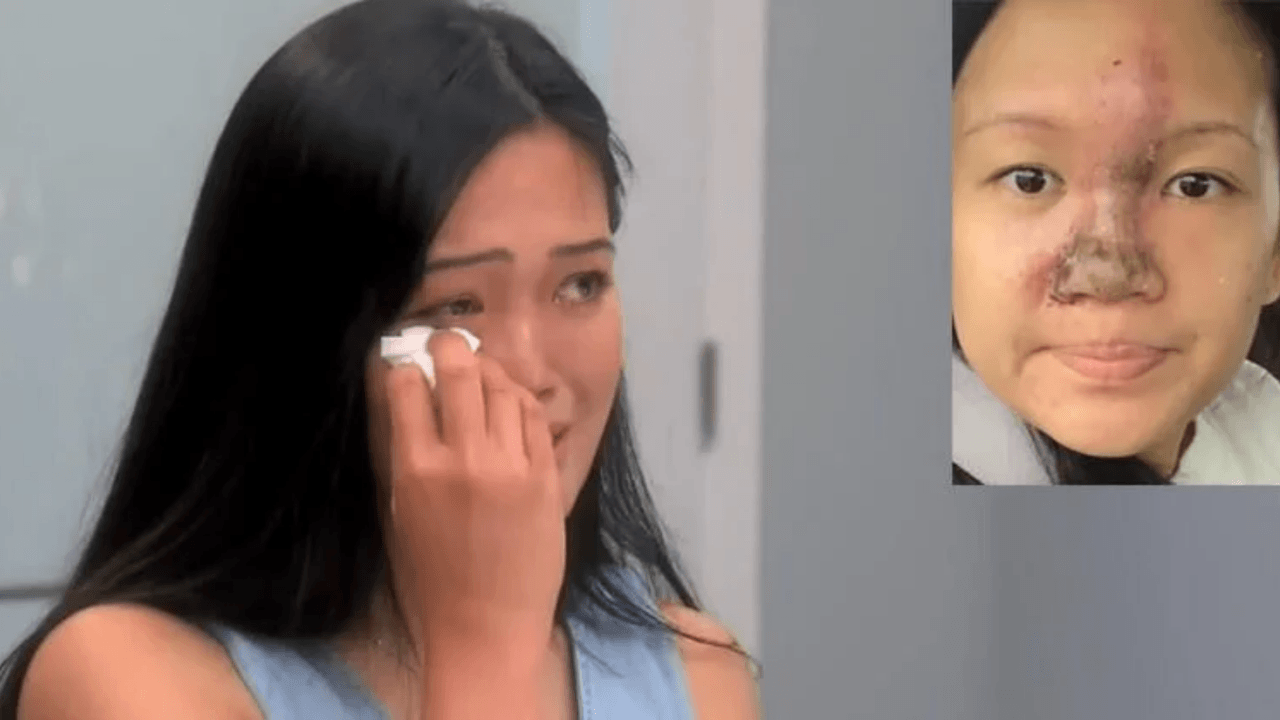 Melisa'nın burnu günden güne eridi