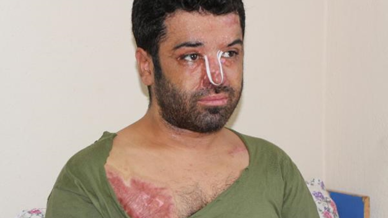 Epilepsi nöbeti sonrası sıcak suya düştü