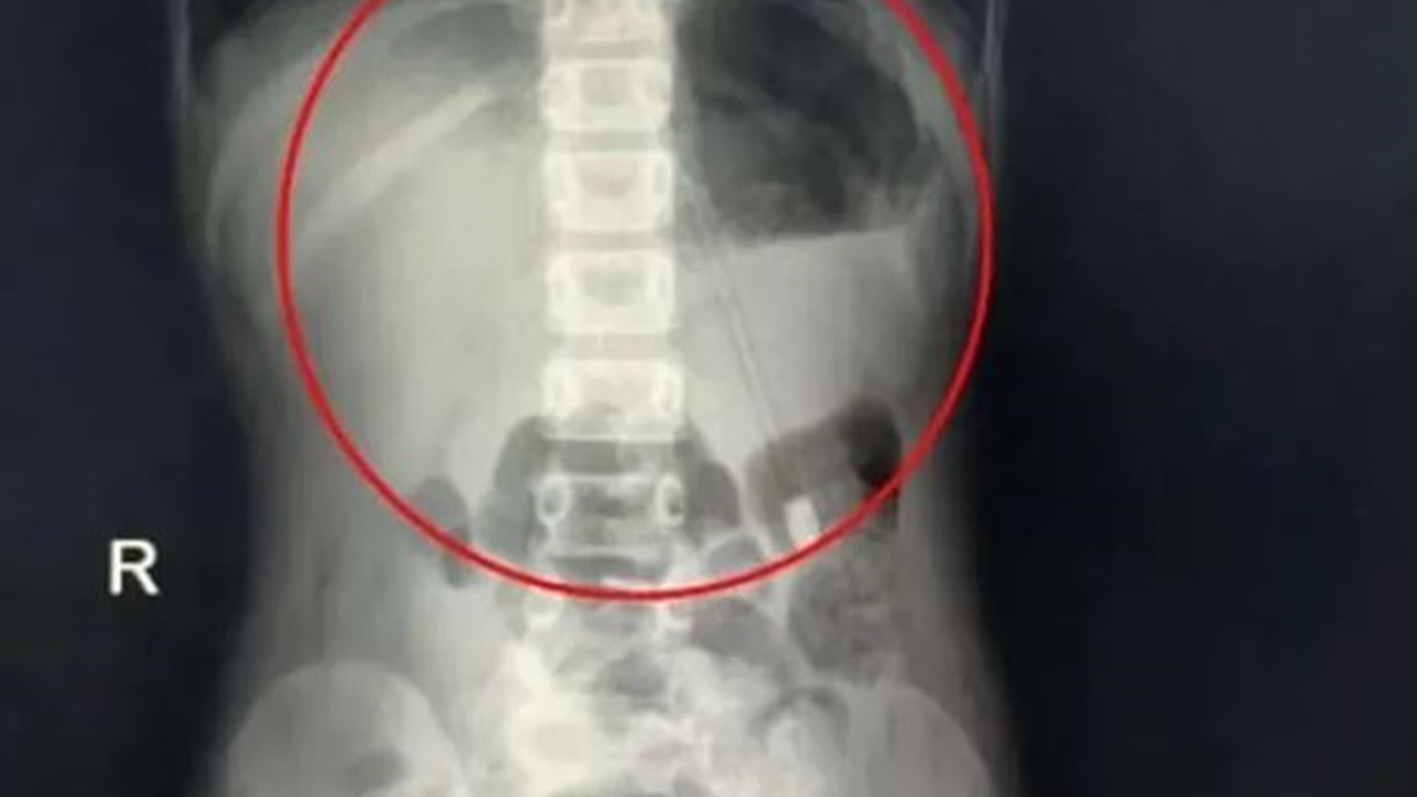 7 yaşındaki çocuğun boğazından 18 cm kalem çıkarıldı