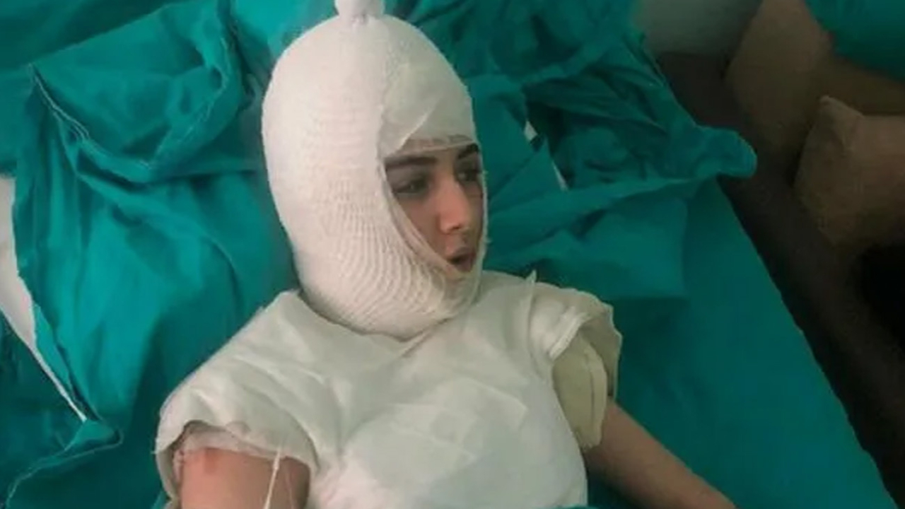 Üvey anne genç kızın başından aşağı kaynar su dökmüştü...