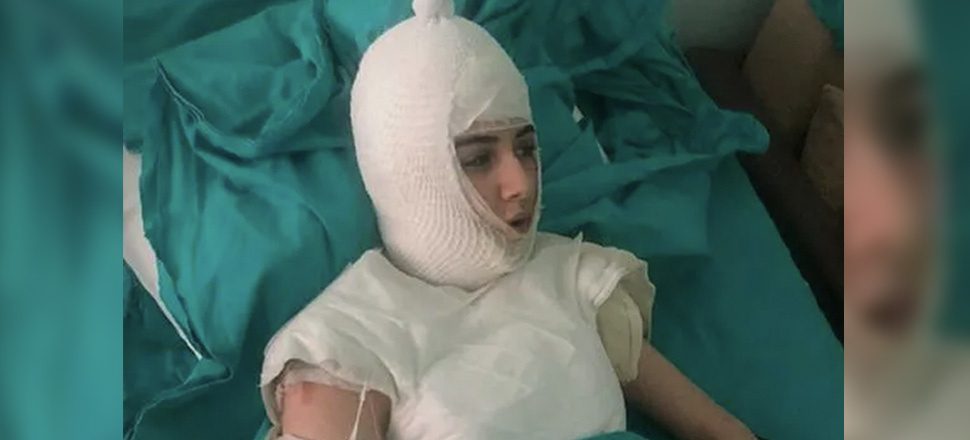 Üvey anne genç kızın başından aşağı kaynar su dökmüştü...