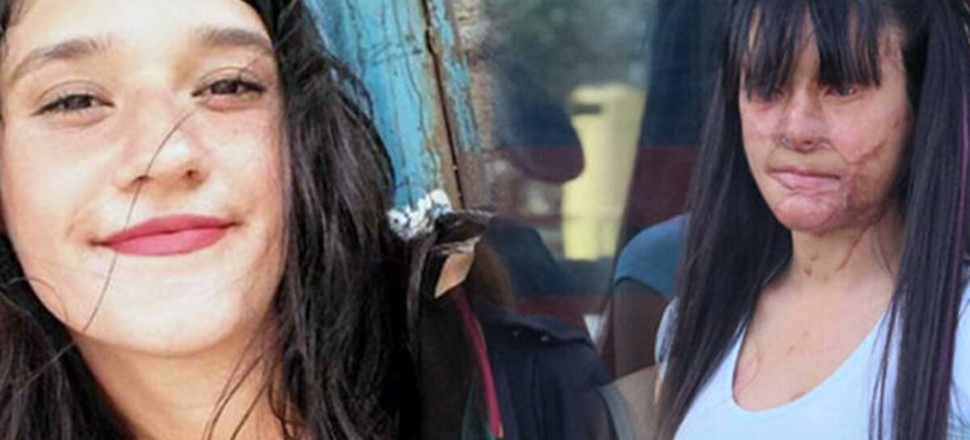 Yüzüne asit döken adamı affeden Berfin: "Bunu nasıl yapabildim"