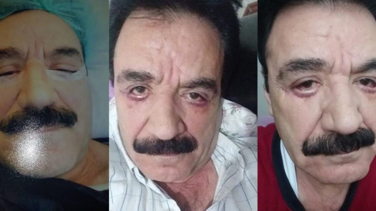 'Göz kapaklarımı kestiğini gördüm!'
