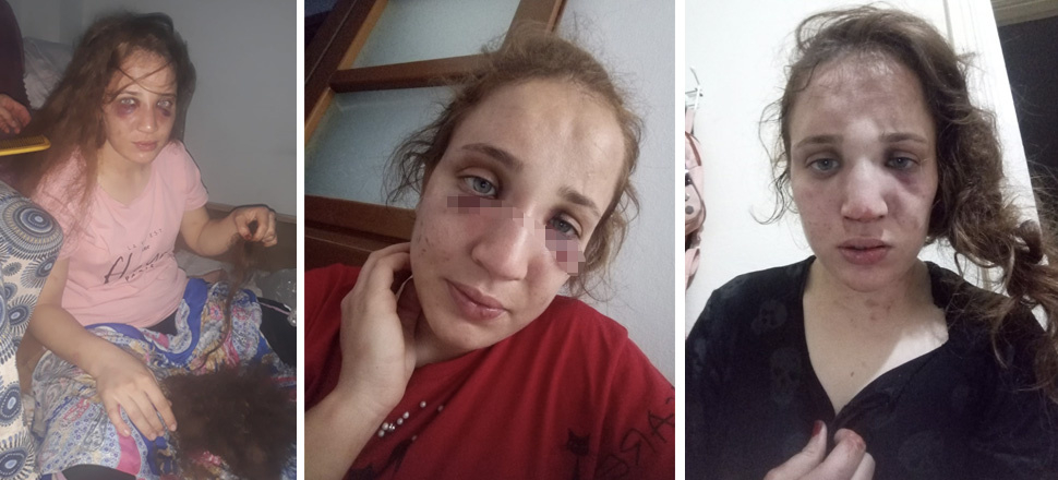 3 çocuk annesi Özlem'i kocası bu hale getirdi!
