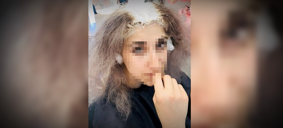 Saçlarını boyatmak için kuaföre gitti kafatası derisi yandı!